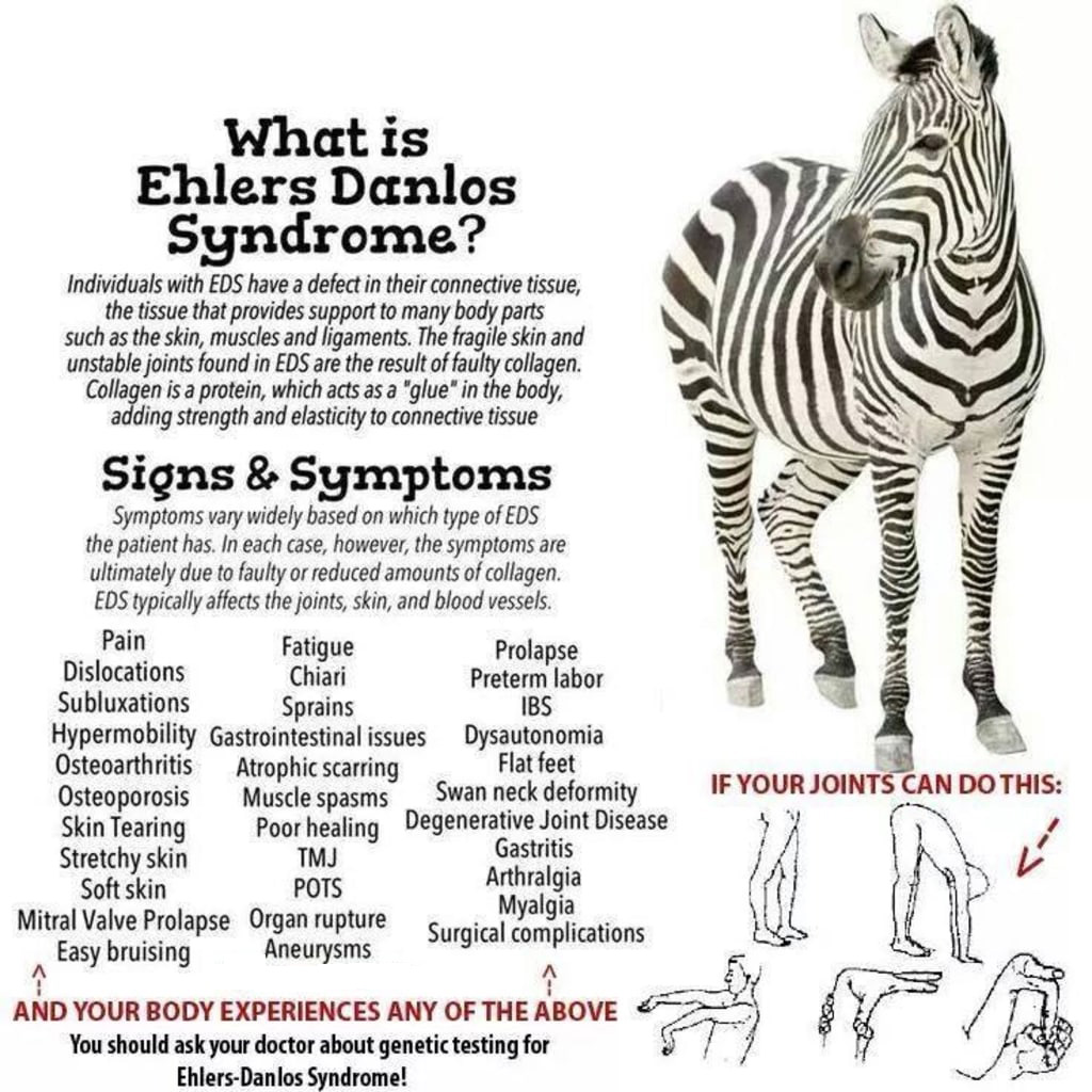 Types of Ehlers-Danlos Syndrome (EDS)